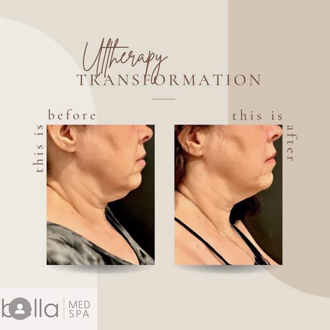 Ultherapy Before And After Treatment | Clarksville, TN | Bella Med Spa