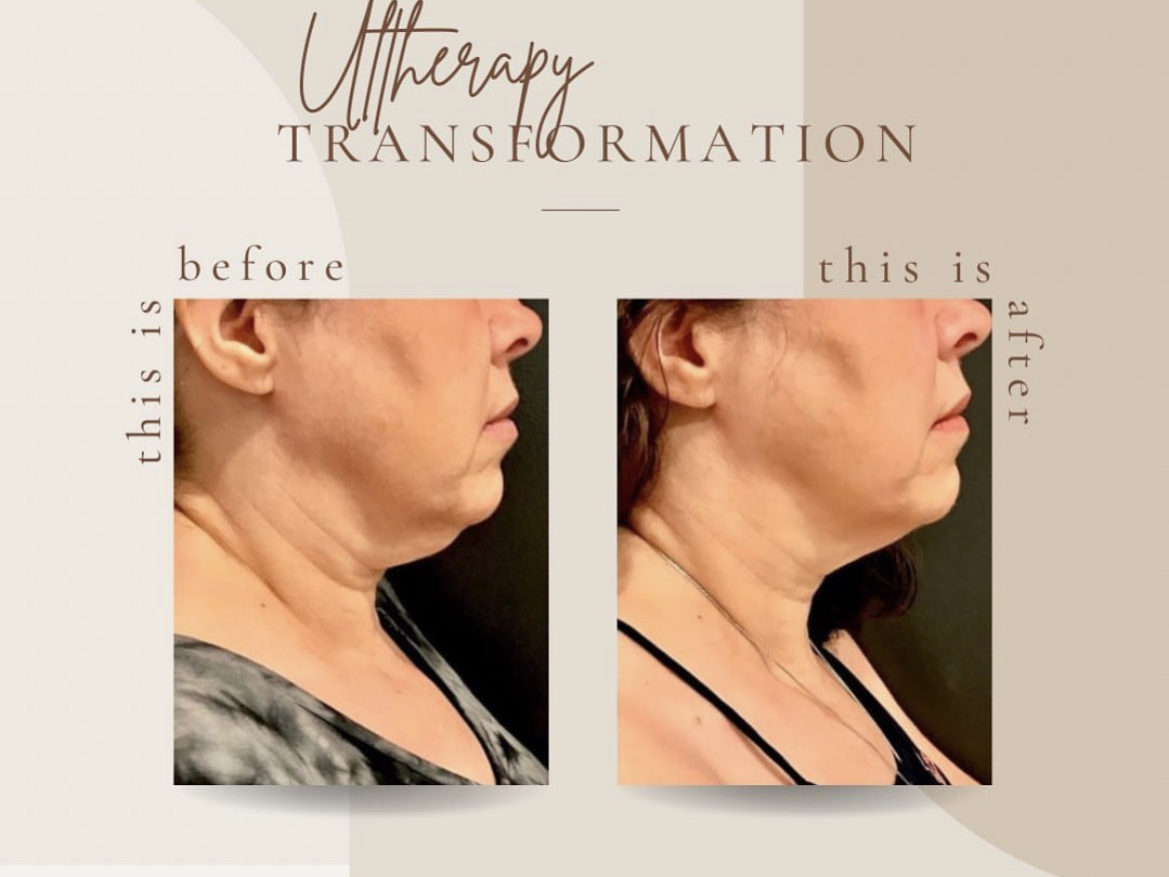 Ultherapy Before And After Treatment | Clarksville, TN | Bella Med Spa