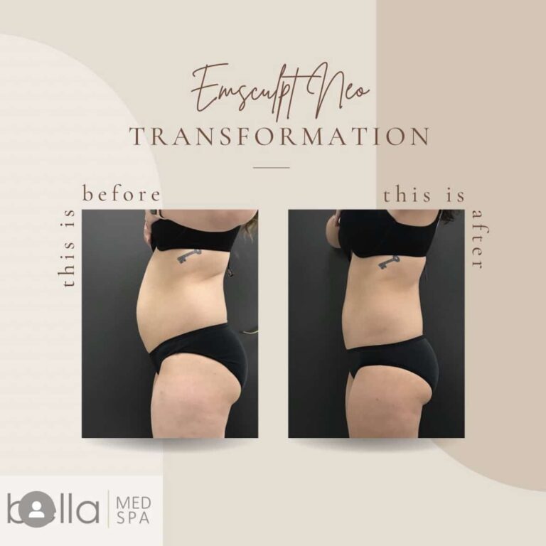 Body Sculpting Before And After Treatment | Clarksville, TN | Bella Med Spa