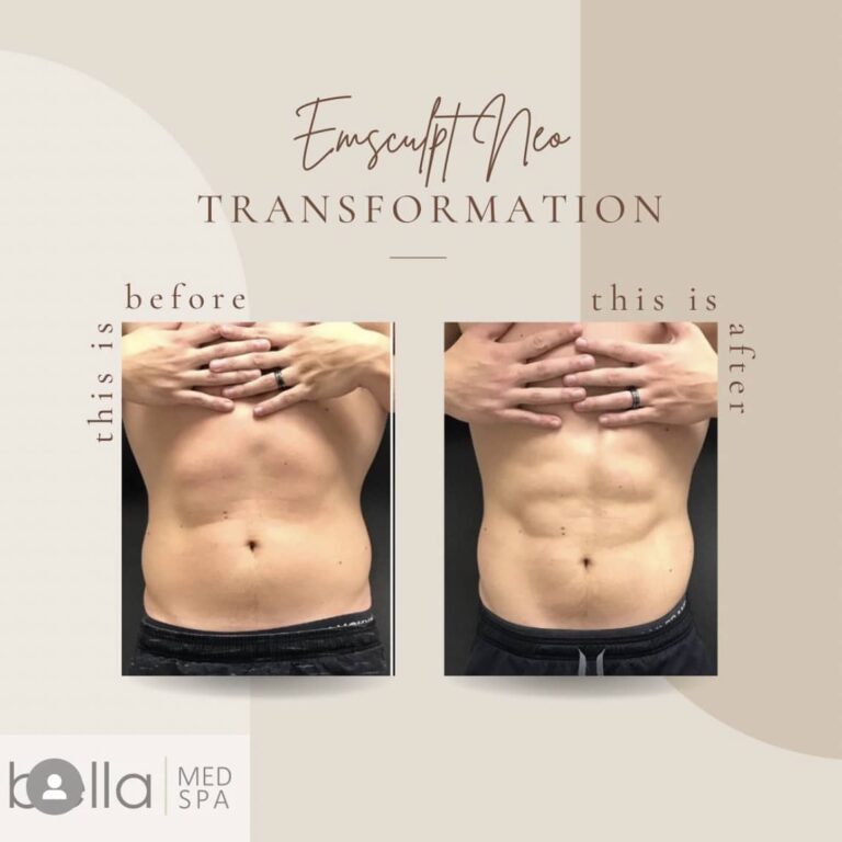 Body Sculpting Before And After Treatment | Clarksville, TN | Bella Med Spa