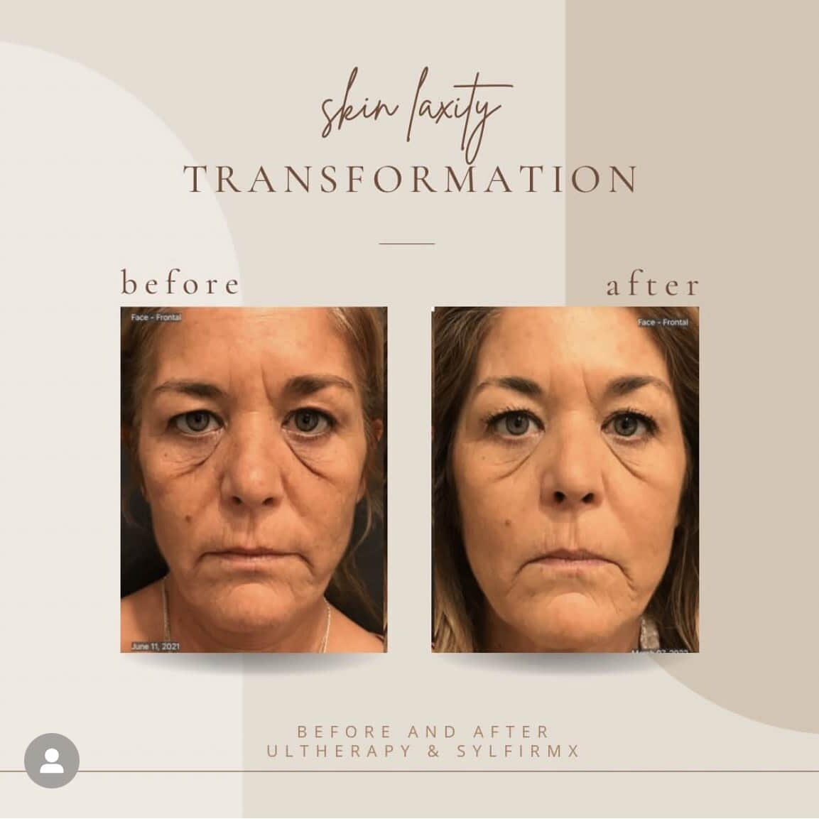 Skin Laxity Before And After Treatment | Clarksville, TN | Bella Med Spa