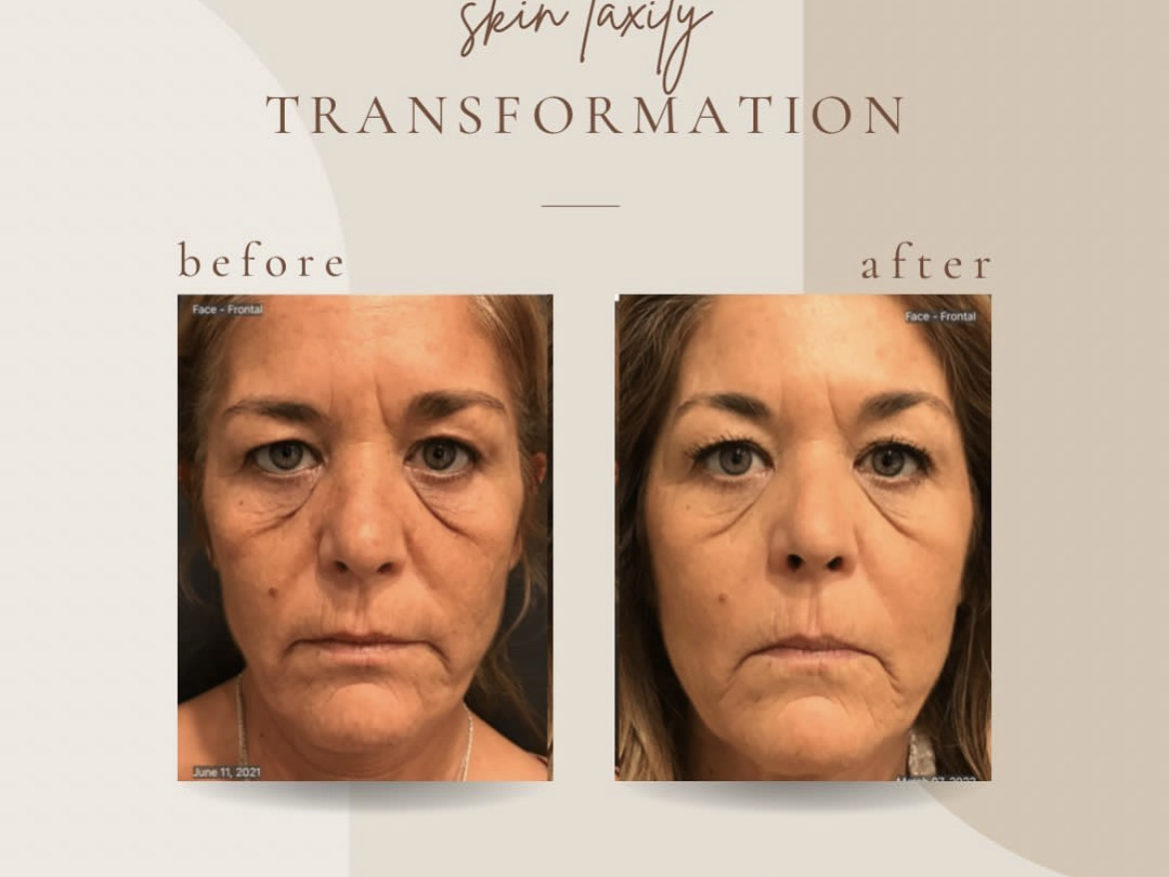 Skin Laxity Before And After Treatment | Clarksville, TN | Bella Med Spa