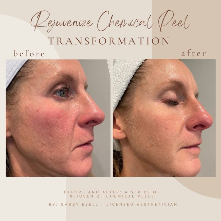 Before And After | Rejuvenize Chemical Peel | Clarksville, TN | Bella Med Spa