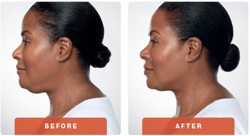 Kybella-Before-After