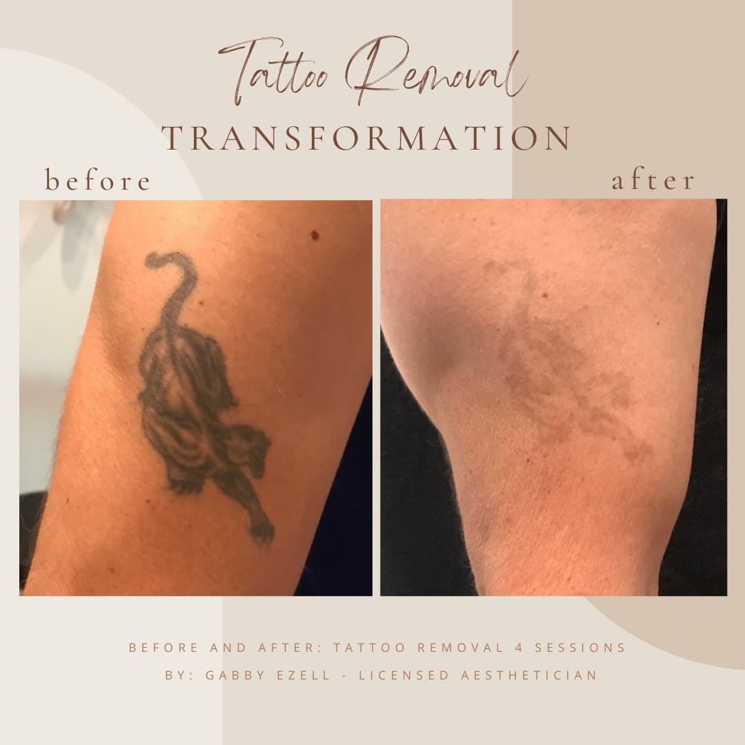 How long will it take before I see my tattoo fade? | North Houston Laser Tattoo  Removal