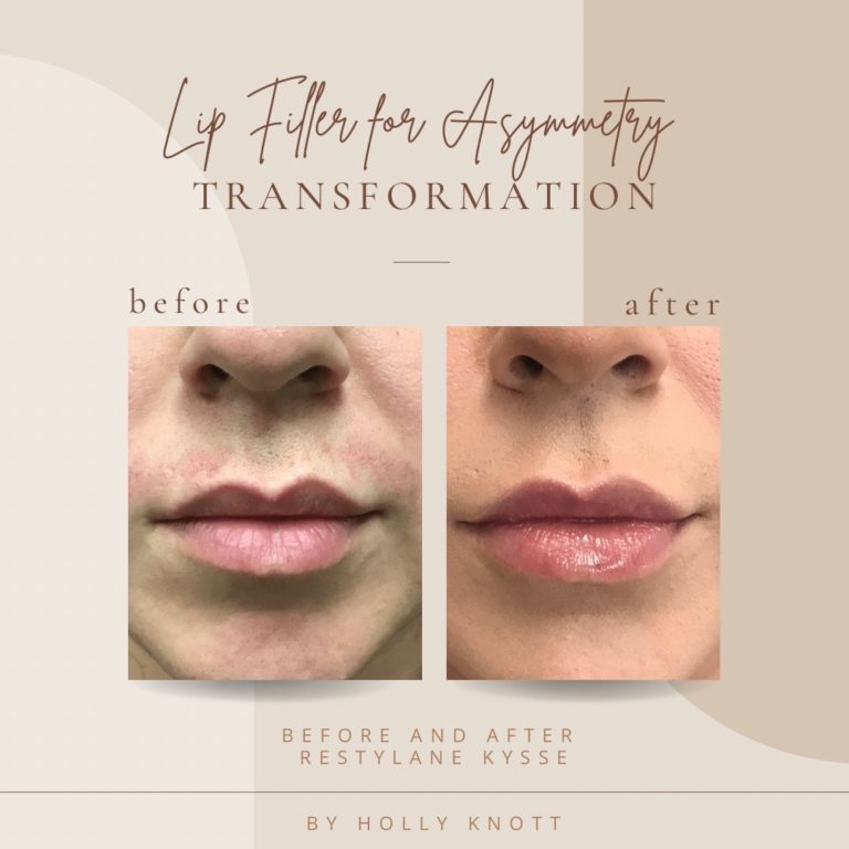 Lip Filler Before And After Treatment | Clarksville, TN | Bella Med Spa