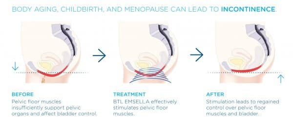 Incontinence Treatment with Emsella