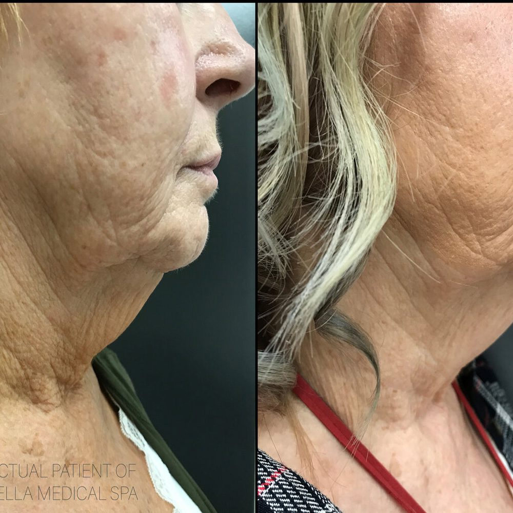Face, Neck & Brow Lift With Ultherapy