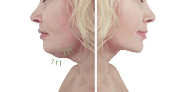 How Good Is Kybella | Bella Med Spa