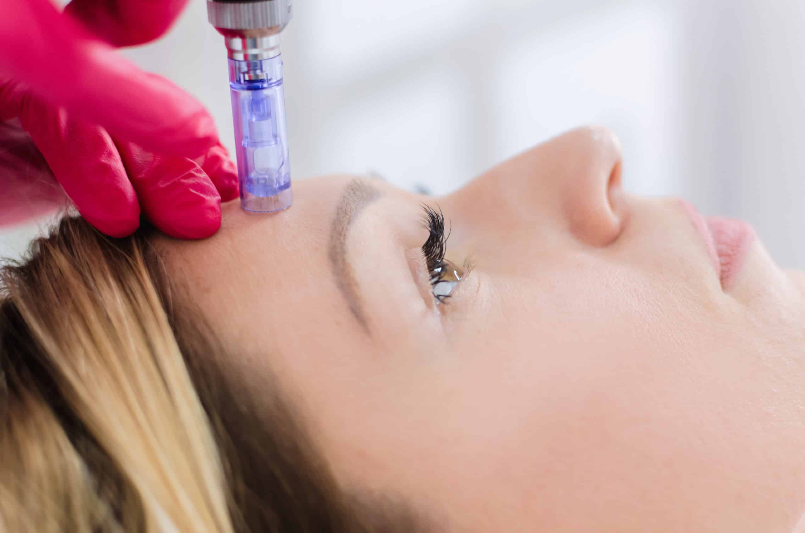 Is Microneedling Helpful for Acne and Injury Scars