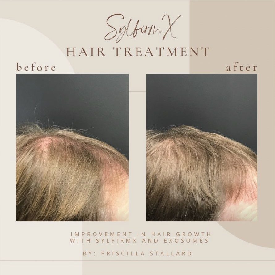 Before And After Hair Treatment | Clarksville, TN | Bella Med Spa