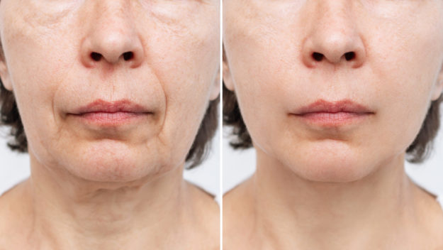 The Incredible Effects of Ultherapy