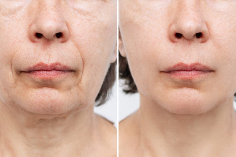 The Incredible Effects of Ultherapy