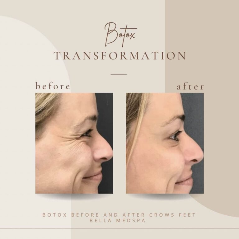 Botox Before And After Treatment | Clarksville, TN | Bella Med Spa