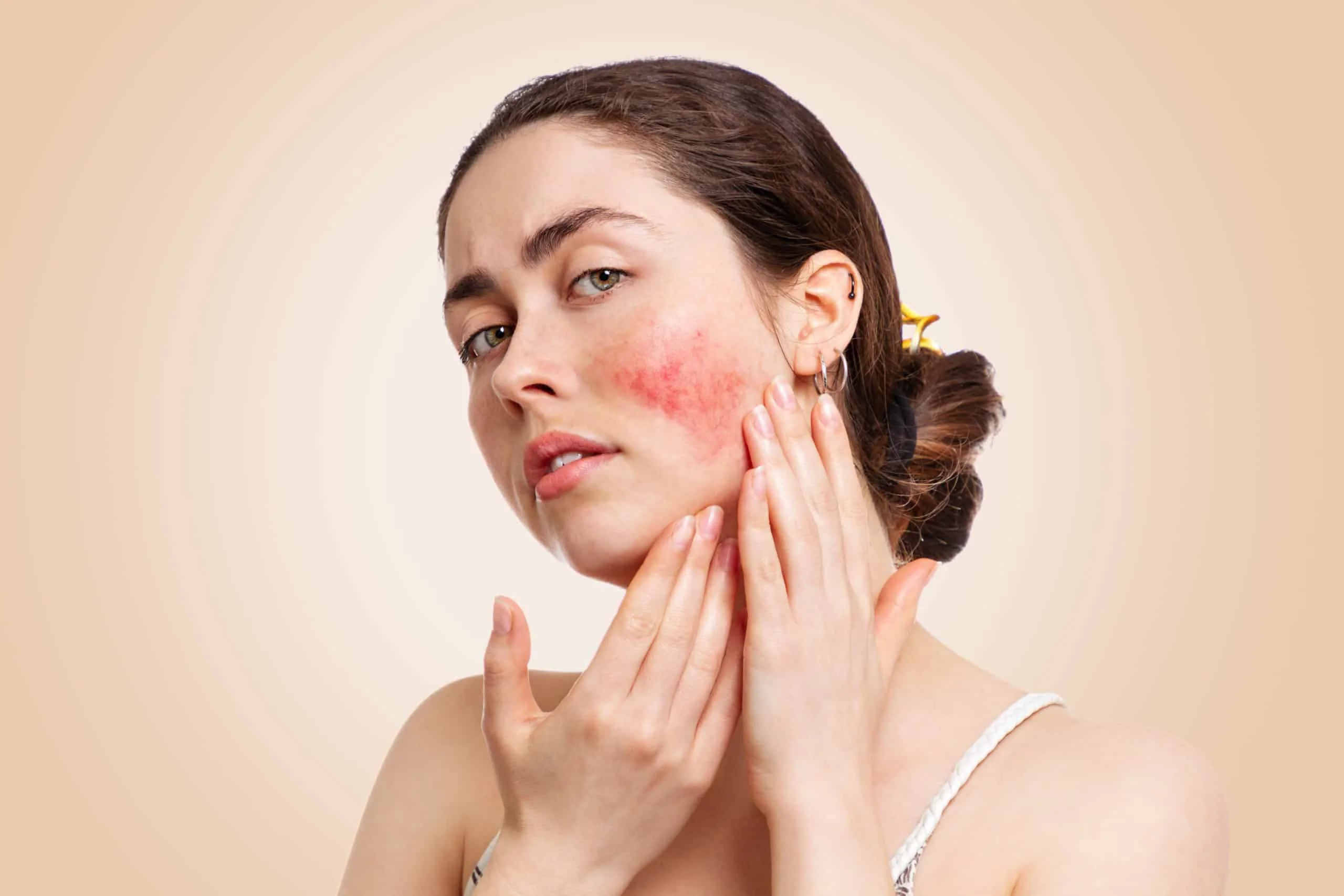 Resolve the Heartbreak of Rosacea