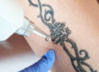 Common Things People Get Wrong About Laser Tattoo Removal