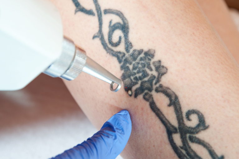 Common Things People Get Wrong About Laser Tattoo Removal