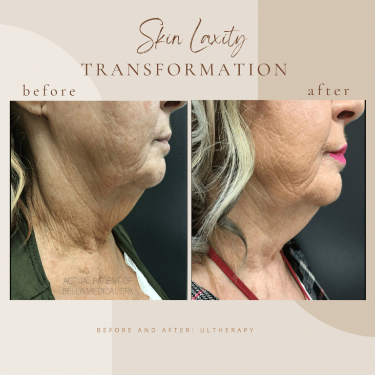 Before And After Skin Laxity | Clarksville, TN | Bella Med Spa