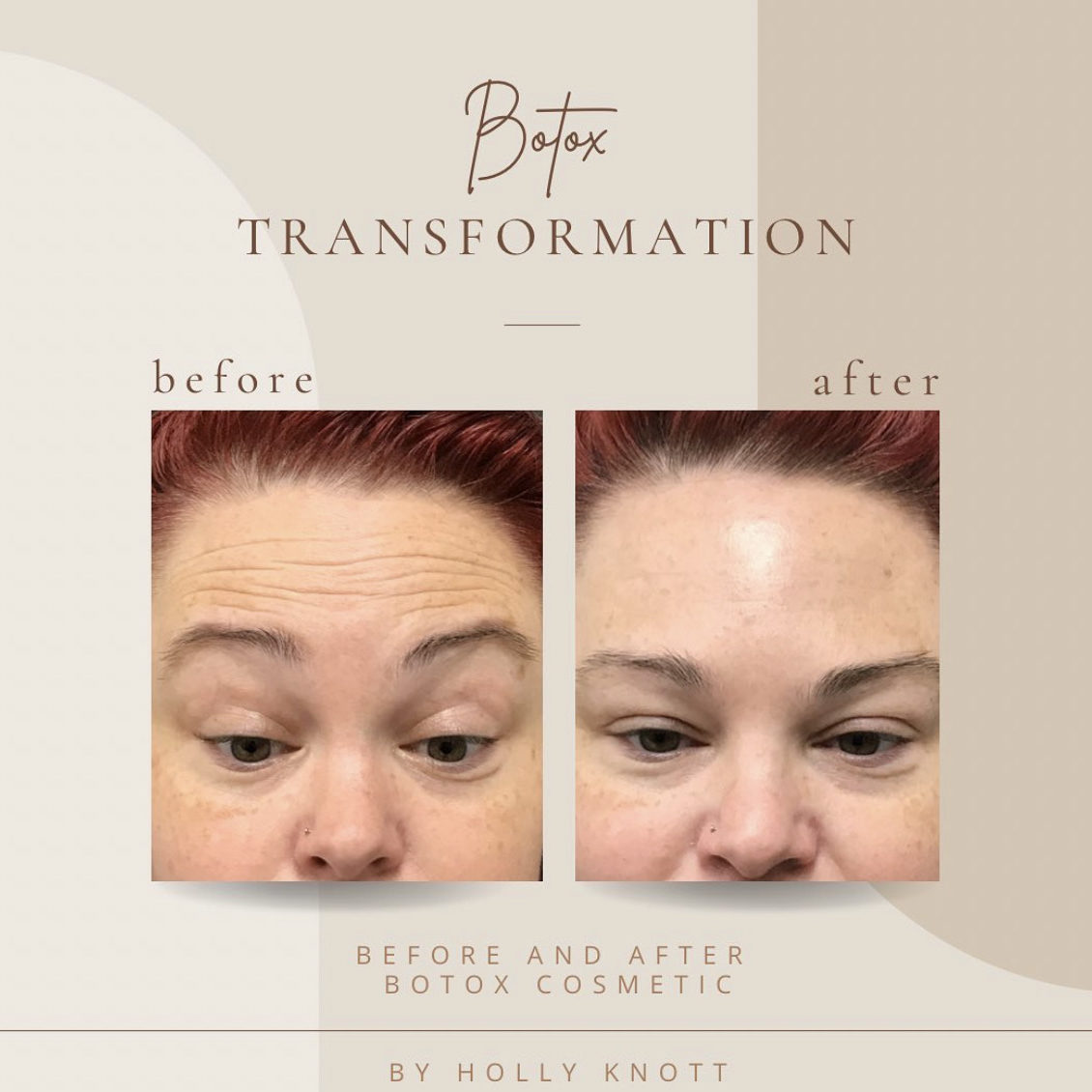Before And After | Botox Transformation | Clarksville, TN | Bella Med Spa