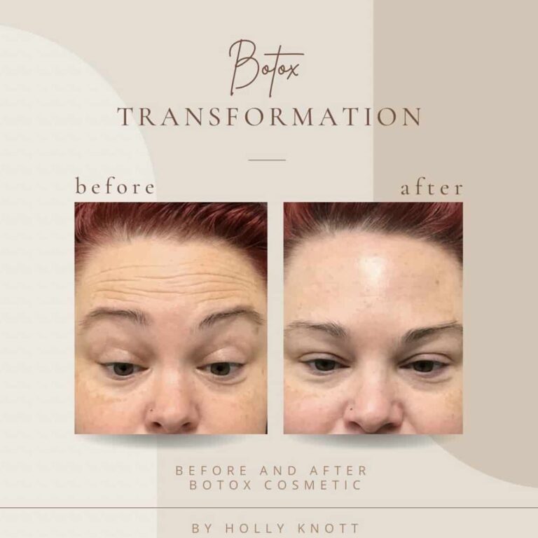 Before And After | Botox Transformation | Clarksville, TN | Bella Med Spa