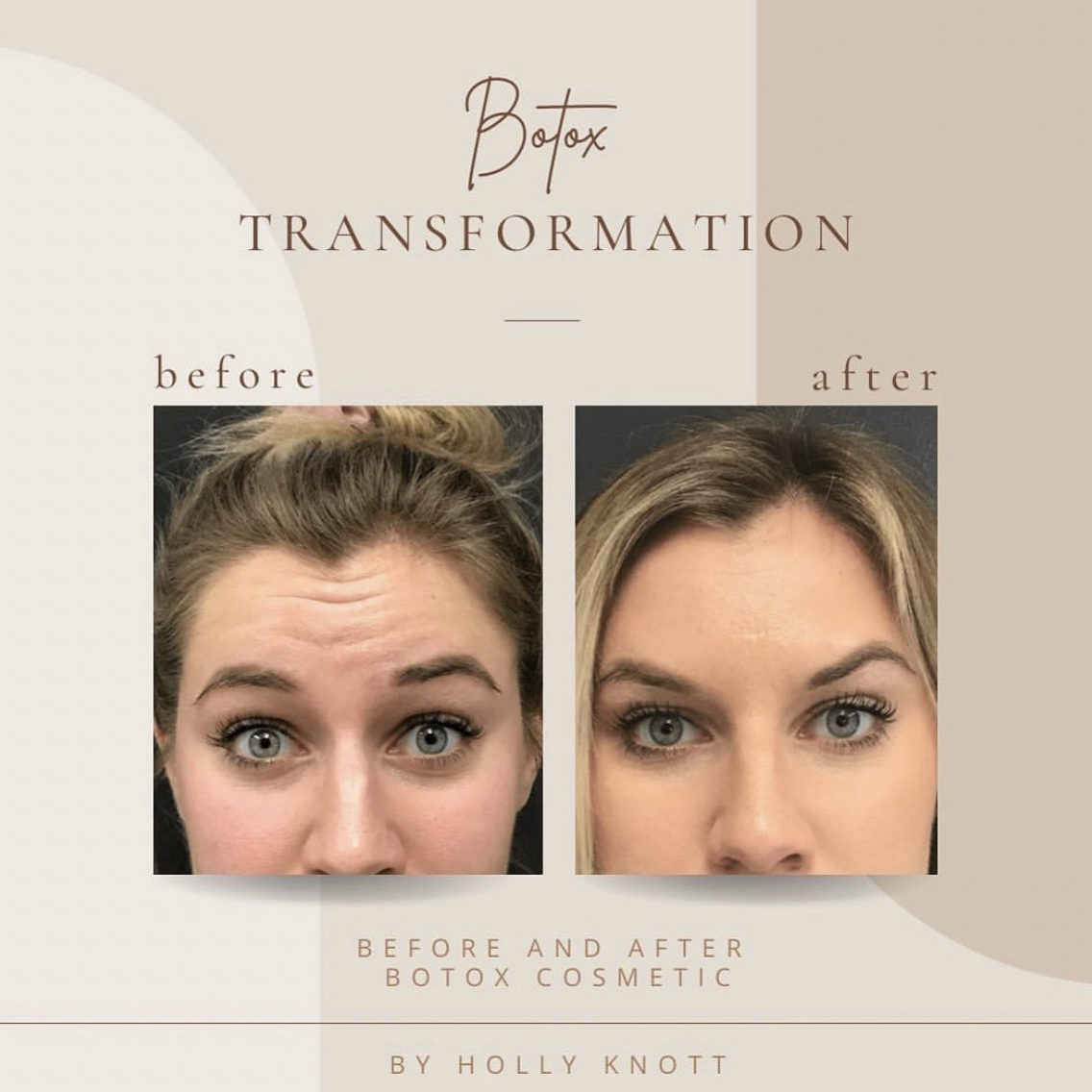 Before And After | Botox Transformation | Clarksville, TN | Bella Med Spa