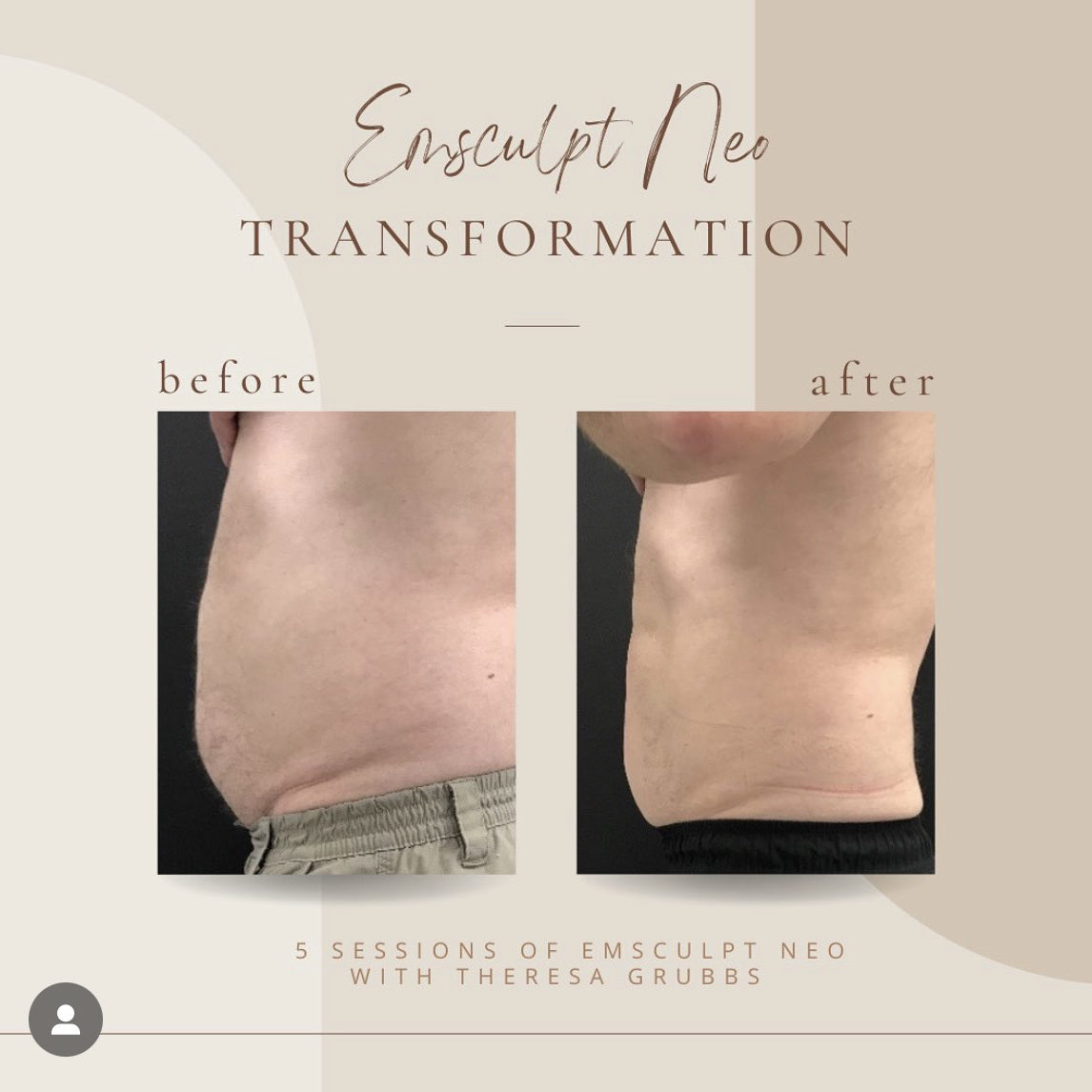 Before And After | Emsculpt Neo | Clarksville, TN | Bella Med Spa