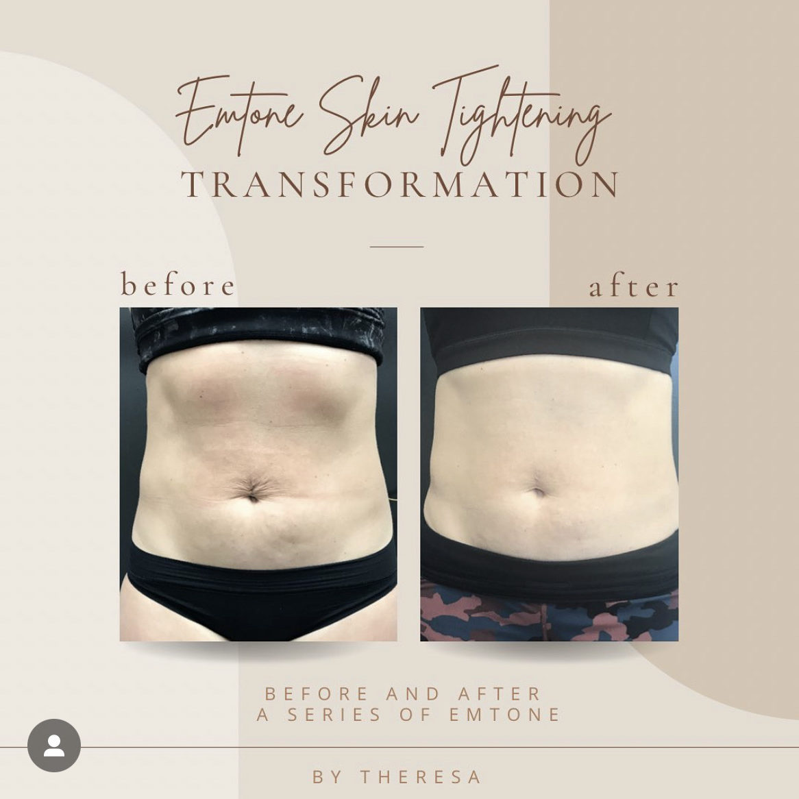 Before And After | Emtone Skin Tightening | Clarksville, TN | Bella Med Spa