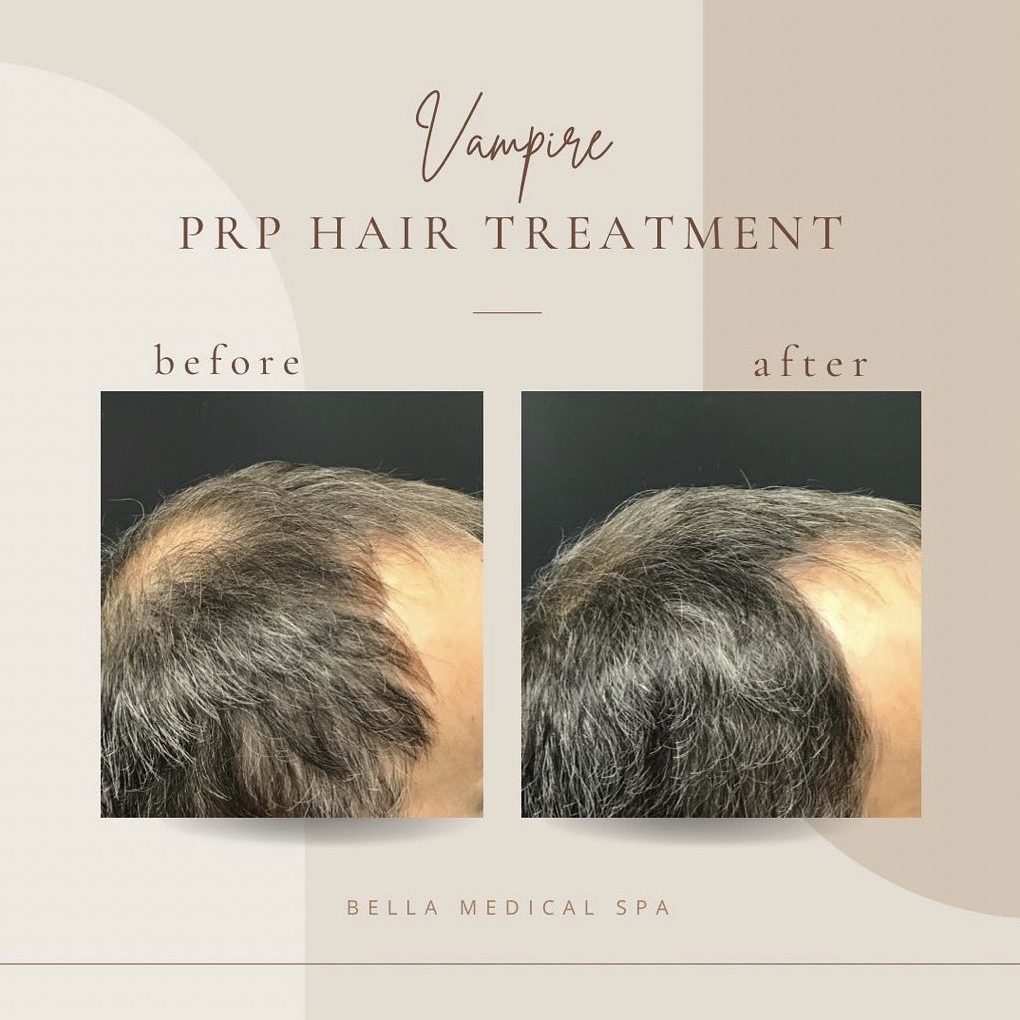 Before and After | Vampire Prp Hair Treatment | Clarksville, TN | Bella Med Spa