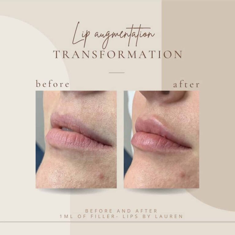 Lip Before And Afters Transformation