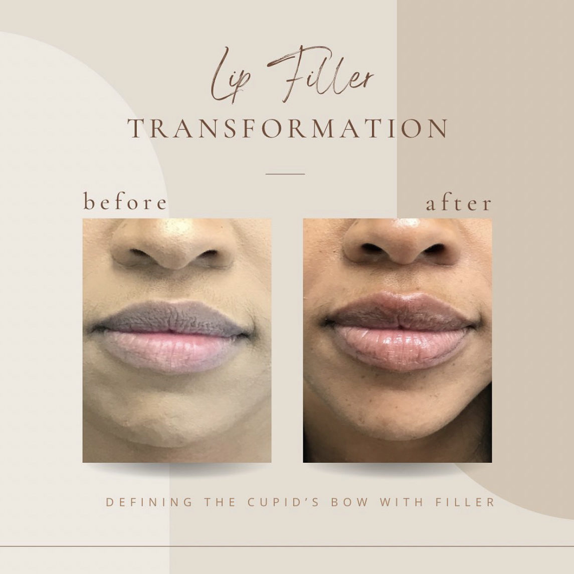 Before And Afters lip filler