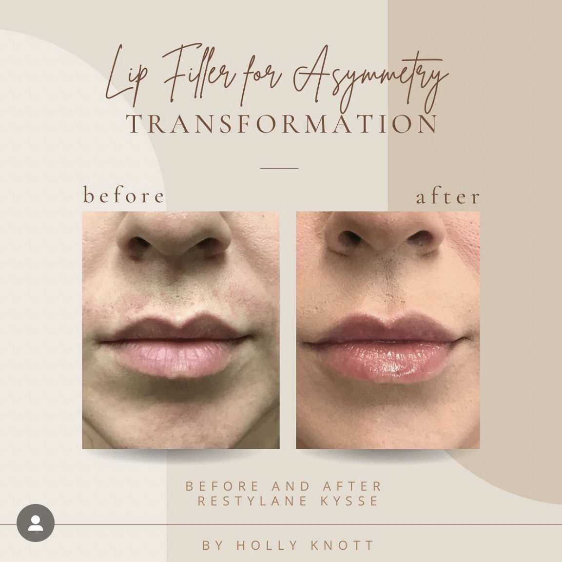 Before And Afters lip fillers