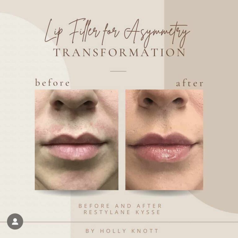 Before And Afters lip fillers