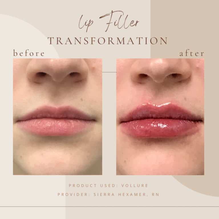 Lip Fillers Before And Afters Transformation