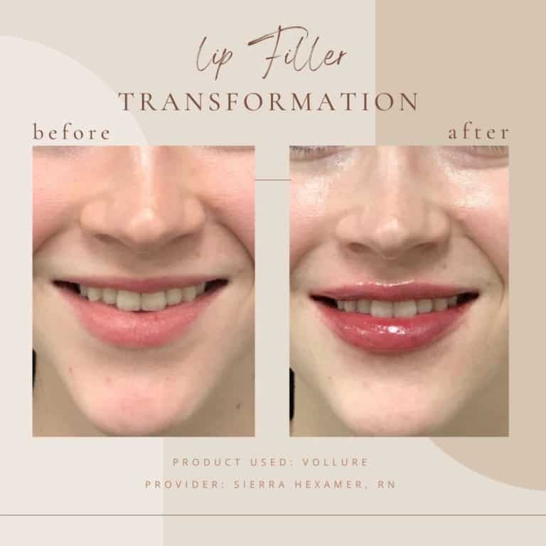 Before And Afters lip