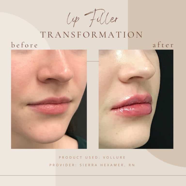 lip fillers