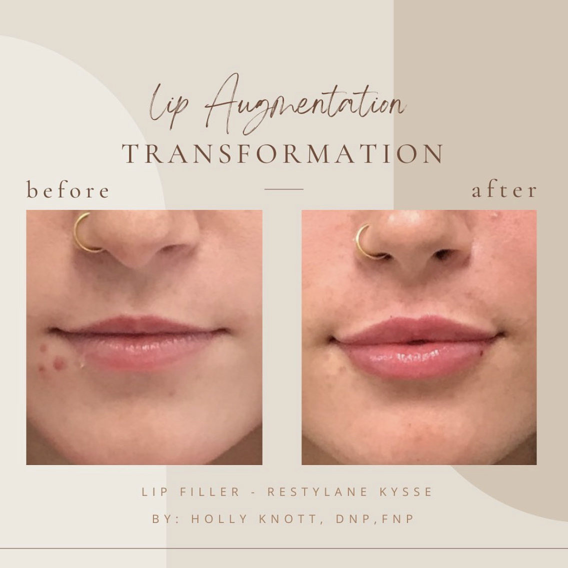 Before And Afters lip Augumentation