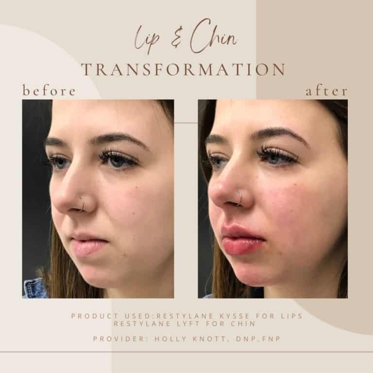 Before And Afters Lip chin transformation