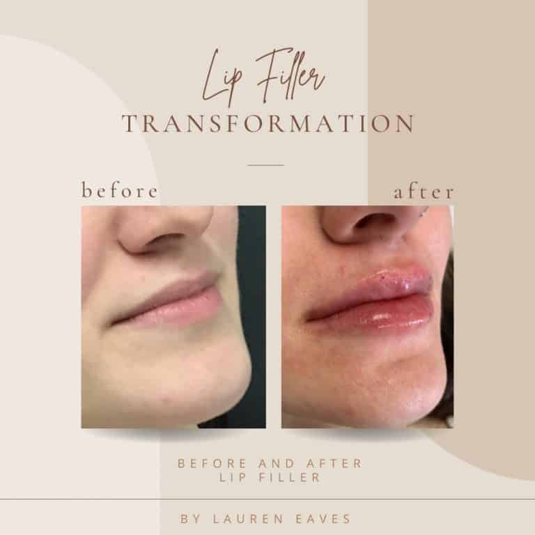 Lip Fillers Before And Afters