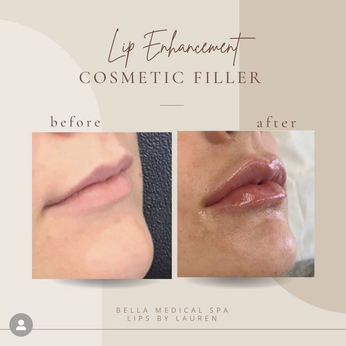 Lip Fillers Before And Afters Transformation