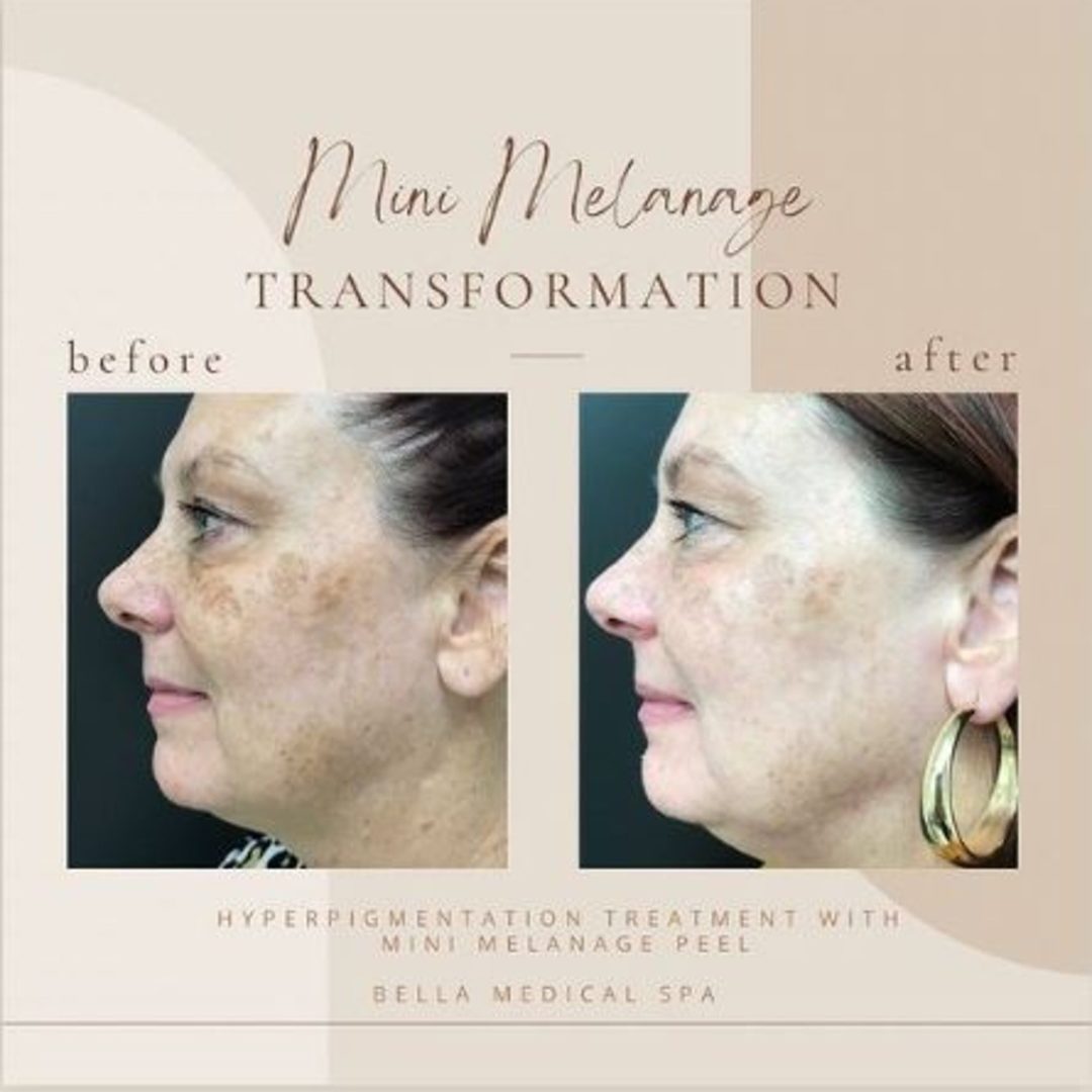 Before And After | Mini Melanage | Clarksville, TN | Bella Med Spa