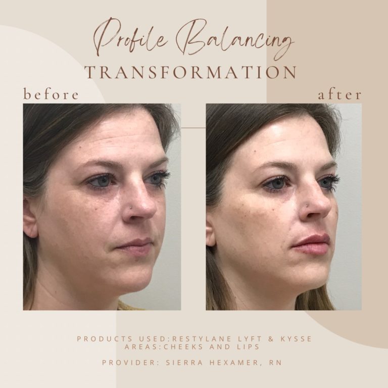 Before And After | Profile Balancing Transformation | Clarksville, TN | Bella Med Spa