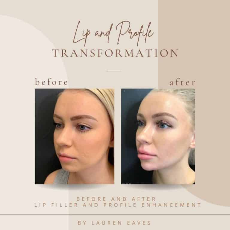 Before And After Lip And Profile | Clarksville, TN | Bella Med Spa