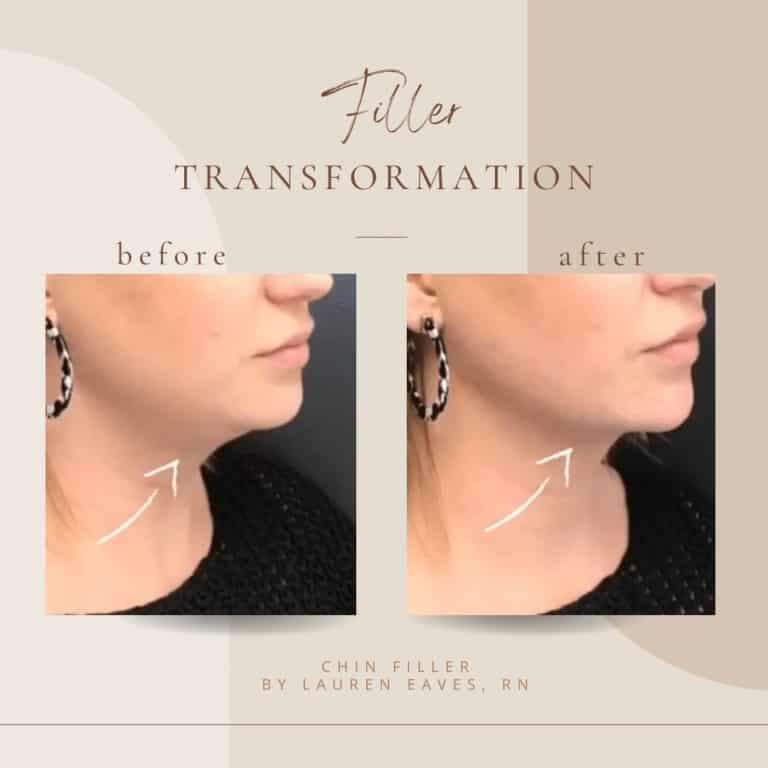 Before And After | Filler | Clarksville, TN | Bella Med Spa