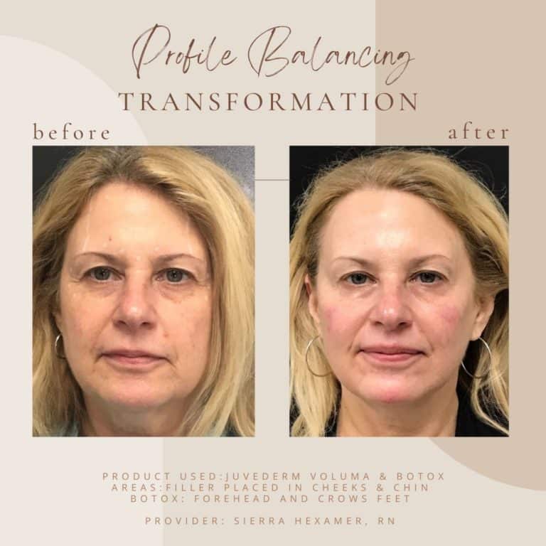 Before And After | Profile Balancing Transformation | Clarksville, TN | Bella Med Spa