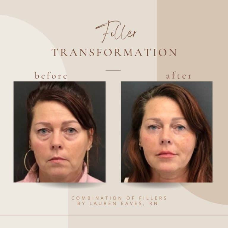 Before And After | Filler | Clarksville, TN | Bella Med Spa