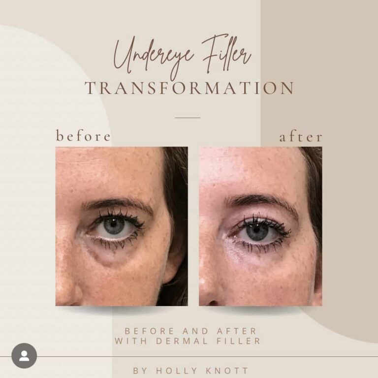 Before And After| UnderEye Filler | Clarksville, TN | Bella Med Spa