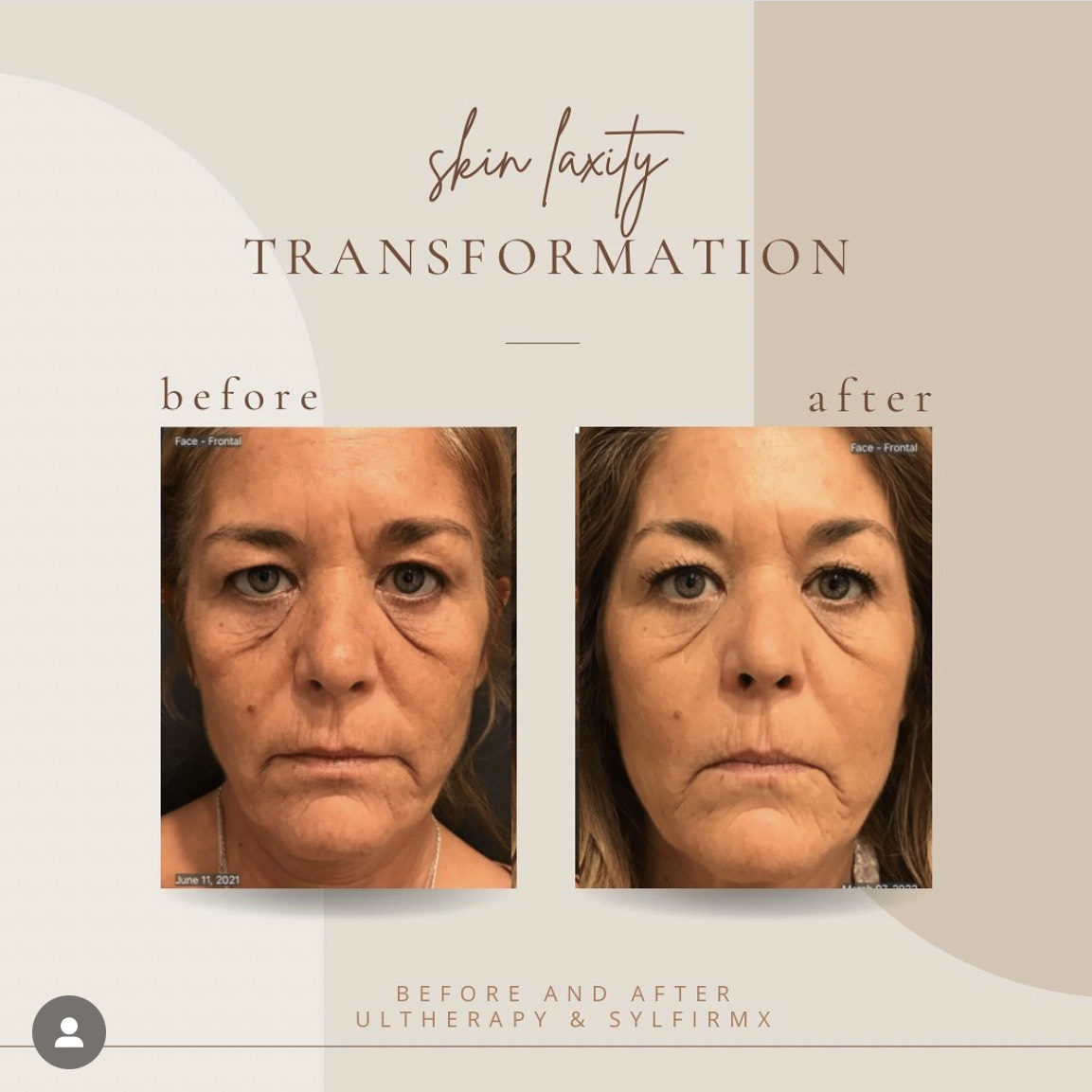 Before And After Skin Laxity | Clarksville, TN | Bella Med Spa
