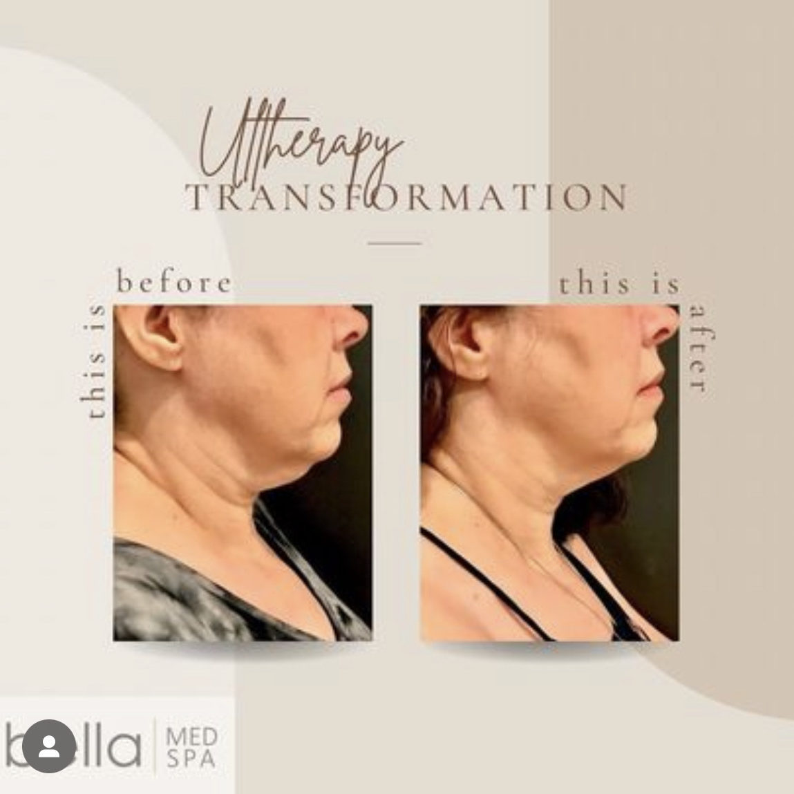 Before And After Ultherapy Transformation | Clarksville, TN | Bella Med Spa