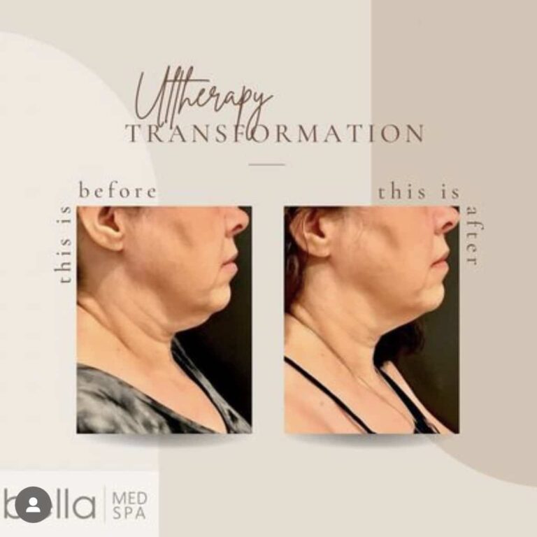 Before And After Ultherapy Transformation | Clarksville, TN | Bella Med Spa