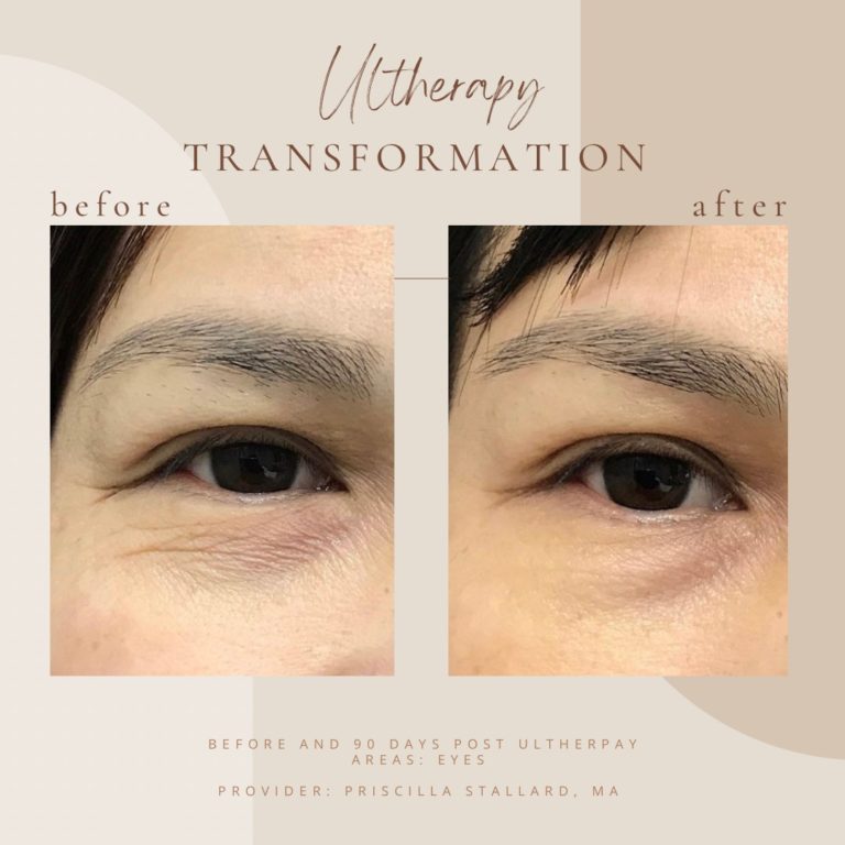 Before And After Ultherapy Transformation | Clarksville, TN | Bella Med Spa